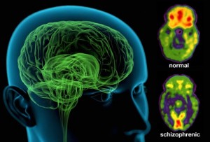 Schizophrenia types,symptoms,causes,risk factors,Tests and Treatment