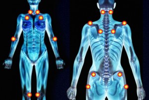 Fibromyalgia Symptoms, Causes, Treatment, Tests and Diagnosis