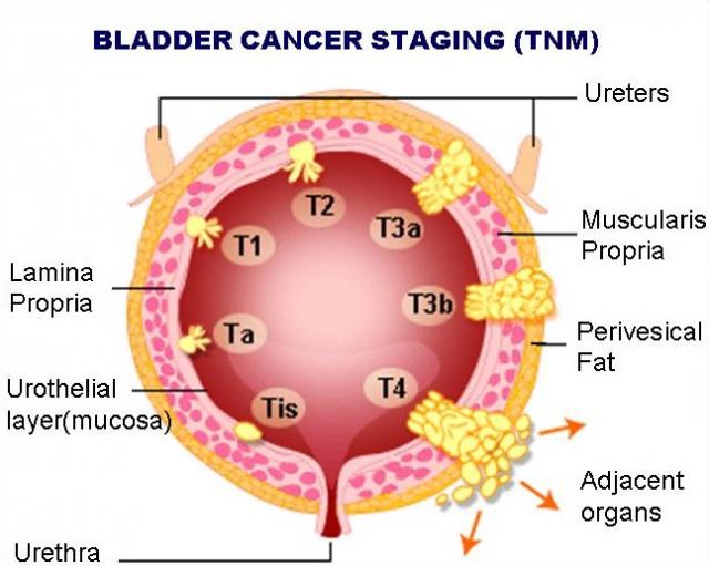 early signs of bladder cancer