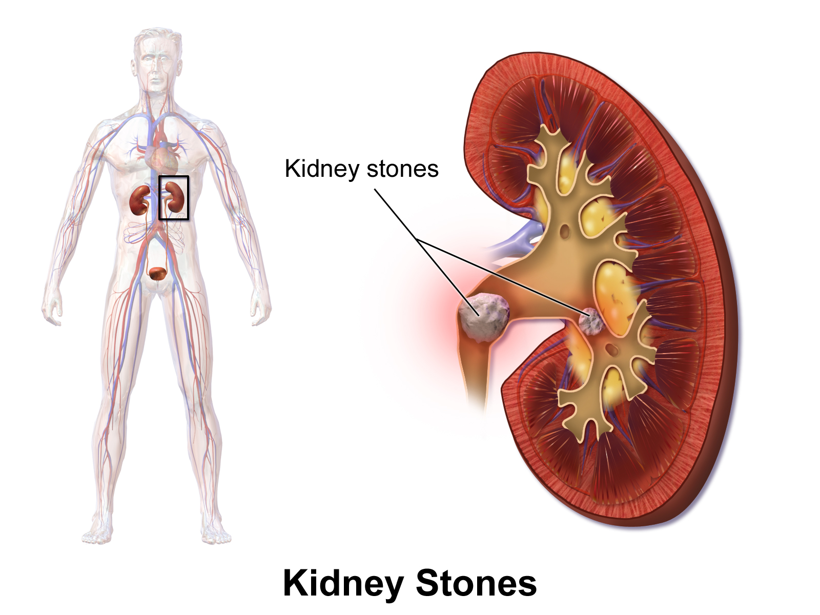 Kidney Stones Symptoms, Causes and Treatment