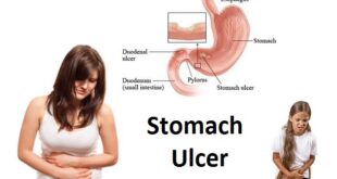 Stomach Ulcer Symptoms in Men, Women Children