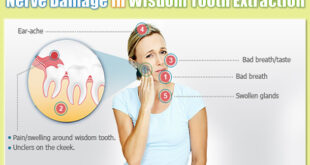 Dental Paresthesia: Nerve damaged after Wisdom tooth extraction