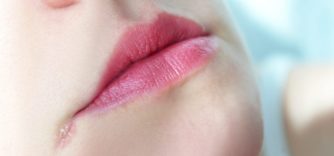 Angular cheilitis: Causes, symptoms, treatment and more