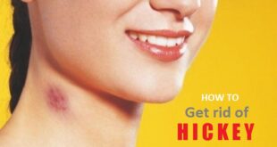 How to get Rid of Hickey on Neck, Lips, Chest Fast Overnight