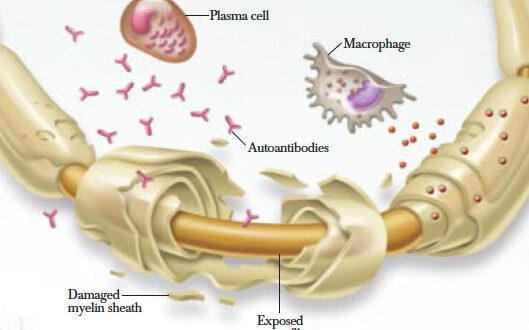 Chronic Inflammatory Demyelinating Polyneuropathy Symptoms Causes