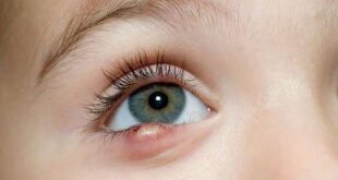 How to Get Rid of Stye on Upper/Bottom Eyelid