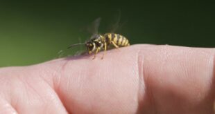 How to Treat Wasp Sting naturally at home