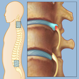Lumbar Radiculopathy Symptoms and Treatment