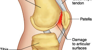Patellofemoral Pain Syndrome Symptoms and Treatment with Surgery, Physical therapy
