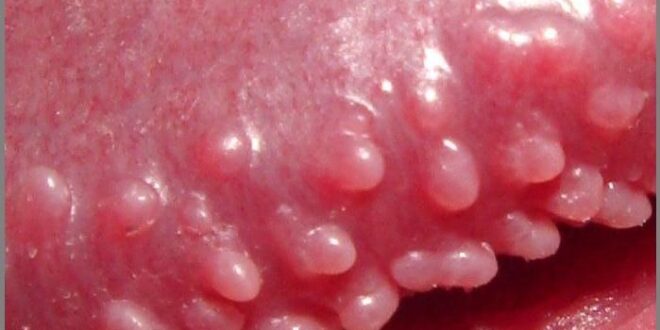 Pearly Penile Papules Ppp Removal Of Bumps Pimples On Penis