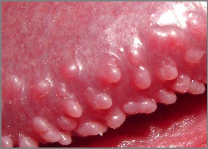 White Papules On Penis 33