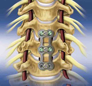 Microdiscectomy Recovery Time, Success Rate, Complications, Cost