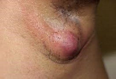 Painful Lump In Armpit During Pregnancy