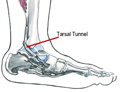 tarsal tunnel syndrome