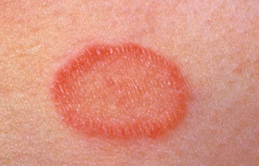 How-to-Get-Rid-of-Pityriasis-Rosea-Naturally-with-Home-Remedies
