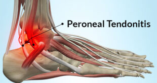 Peroneal Tendonitis Symptoms, Causes, Treatment at Home