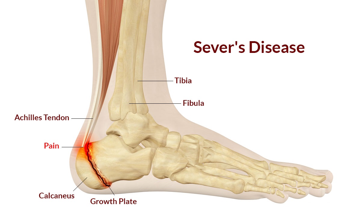 Sever's Disease Symptoms, Causes.