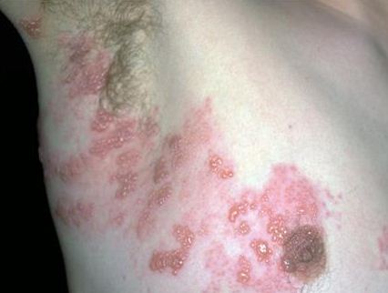 Armpit Rash Pictures Shingles