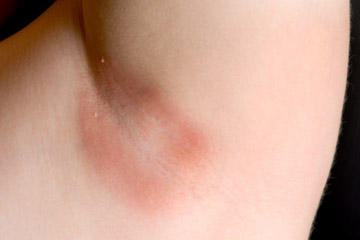 Armpit Rash on Underarm Skin - Pictures of Infection, Yeats, HIV