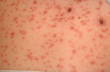 HIV Rash appearance