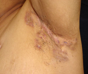 Hidradenitis suppurativa armpit rash