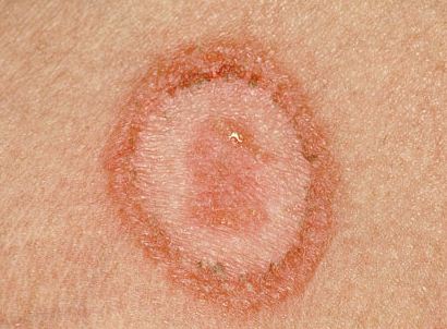 Rash due to ring worms