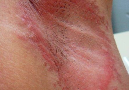 Underarm rash due to deodorant