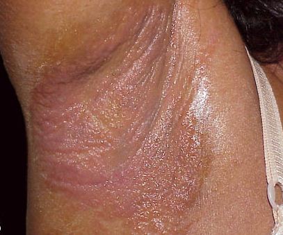 Underarm rash due to due to allergic reaction or contact dermatitis