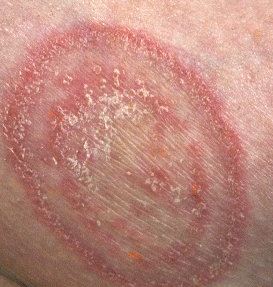 Yeast, fungal or candida armpit rash pictures