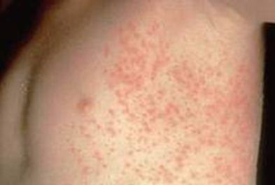 Non steroid treatment for eczema
