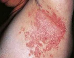 itchy underarm rash picture due to psoriasis