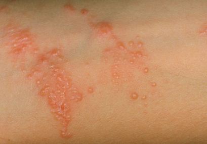 under armpit rash lump sumac pictures - caused by poison in ivy, oak, and sumac plants