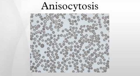 Anisocytosis Definition, Causes, Symptoms, Treatment