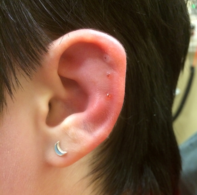 Infected Cartilage Piercing Symptoms, Treatment