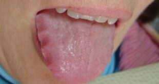 Scalloped Tongue Pictures, Causes, Treatment