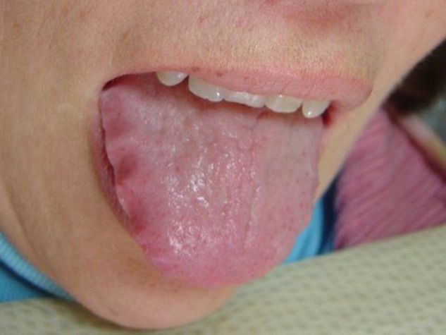 Scalloped Tongue Pictures, Causes, Treatment