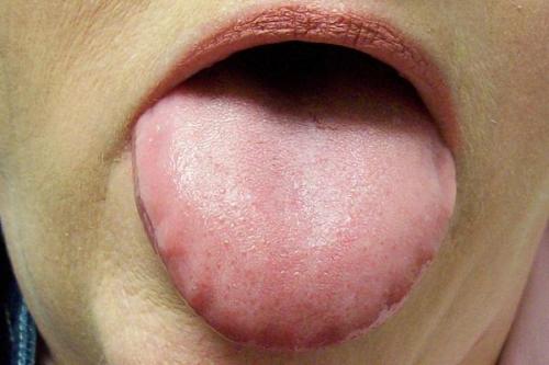 Scalloped Tongue Pictures