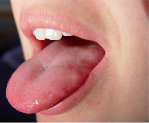 Scalloped Tongue Pictures