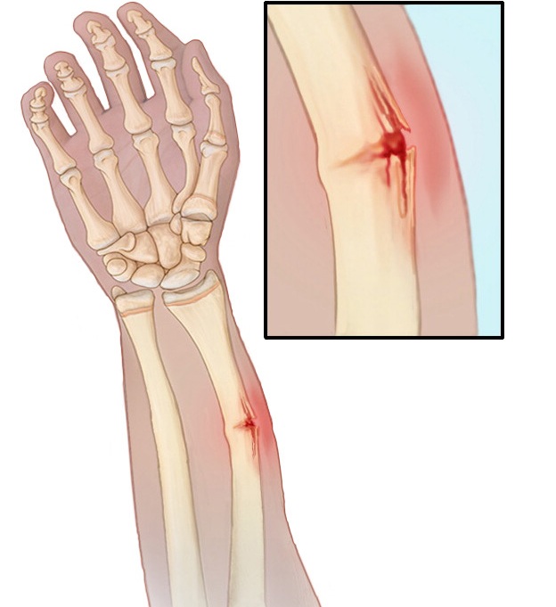 radial and ulnar torus fracture