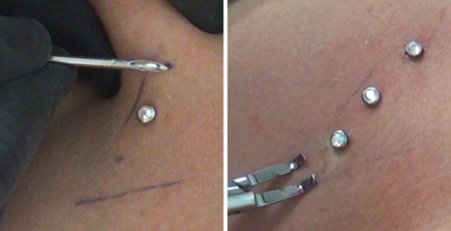 Dermal Piercings - Procedure, Removal, Prices, Pictures