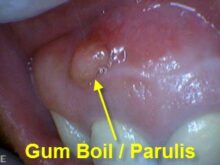 What causes bumps on your gum?