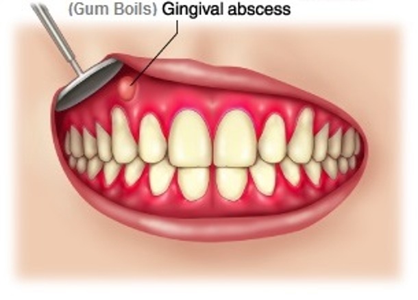 gum-boils-abscess-lump-blister-pimple-pictures-and-treatment