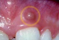 Gum Boils (Abscess)