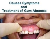 Causes of gum boils