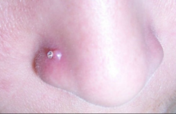 Nose Piercing Bump Infection Keloid Lump On Ring Causes Treatment