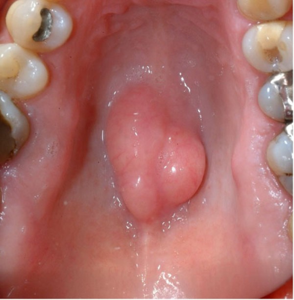 Cyst On Roof Of Mouth 56