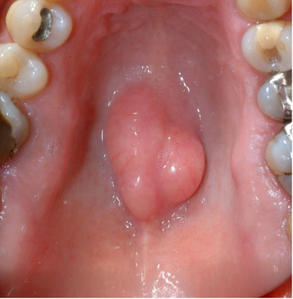 Hard Lump Roof Of Mouth 44