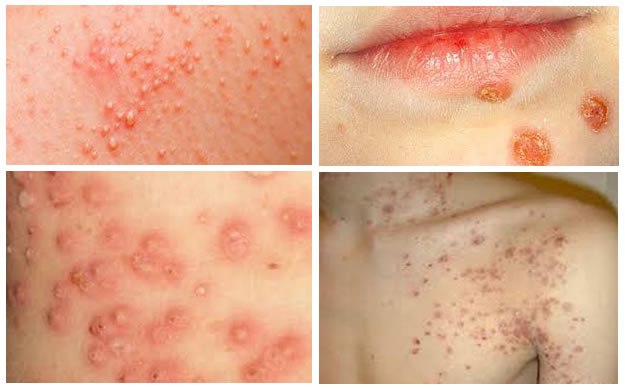 Infantigo (Impetigo): Causes, Symptoms and Treatments