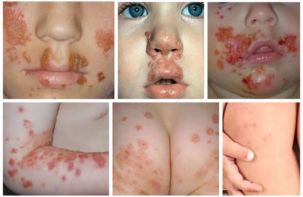 Infantigo - Pictures, Rash Causes, Symptoms, Treatment ...