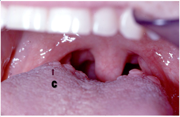 Circumvallate Papillae Function, Enlarged Causes, Treatment